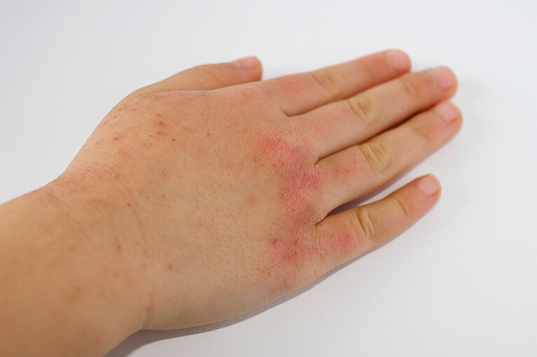 リウマチ性疾患で発疹が生じるのはなぜですか?